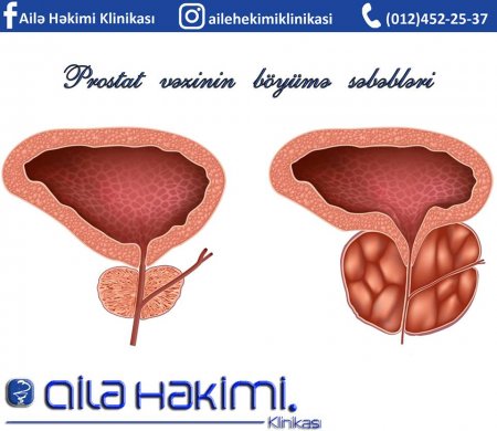Ailə Həkimi Klinikası-Prostat vəzinin böyümə səbəbləri