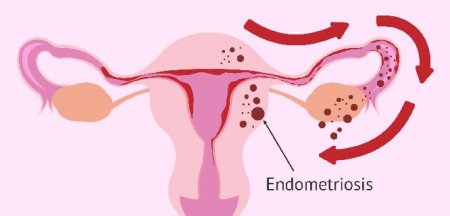 Endometrioz nədir?