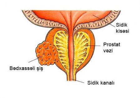 Prostat vəzinin xərçəngi