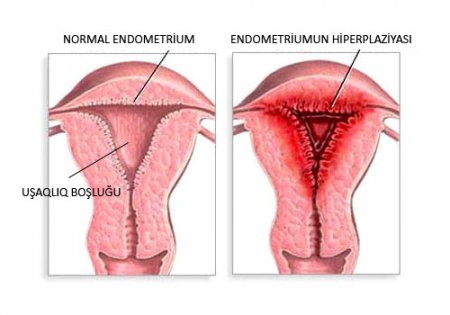 Qadınların diqqətinə! Endometriumun hiperplaziyası təhlükəlidir