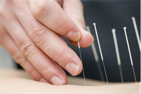 Akupunktura nədir?