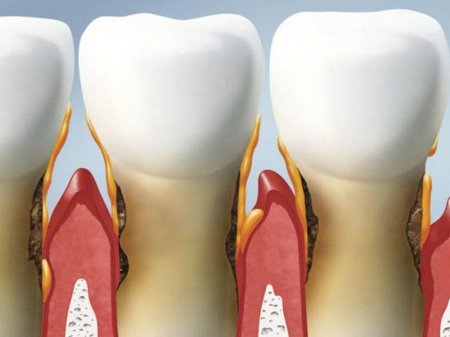 Həm diş əti xəstəliyi, həm də şəkərli diabeti olanlarda bu risklər daha yüksəkdir
