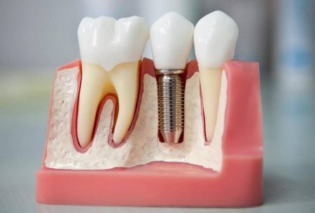 Diş implantını hamıya qoymaq olmaz - Fəsadlar yaranır