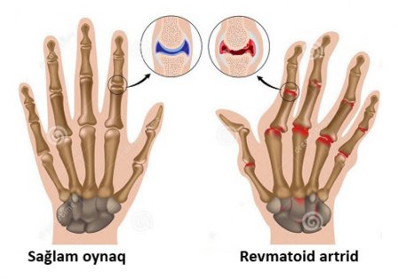 Revmatoid artrit - ağır oynaq xəstəliyi