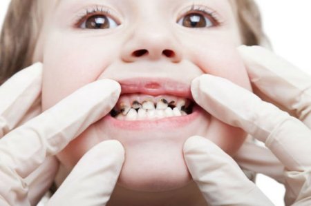 Erkən yaşda dişlərin çürüməsinə səbəb nədir?