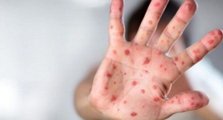 Hansı allergik reaksiyalar zamanı antibiotik təyin edilməlidir? - AÇIQLAMA