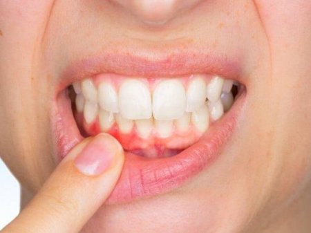 Dişlərin həssaslığının artması