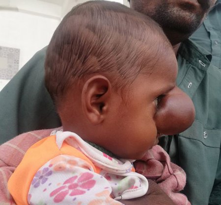 TİBB DÜNYASI ŞOKDA: Beyni burnunda yerləşən uşaq doğulub – FOTO