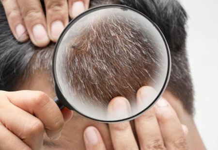 Saçın erkən ağarmasının səbəbi nədir? - Mütəxəssis AÇIQLADI