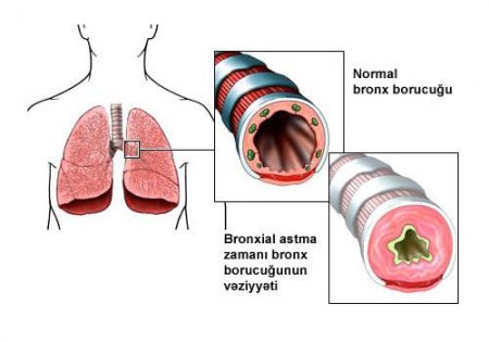 Uşaqlarda bronxial astma xəstəliyi