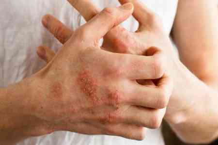 İnsanda allergiya necə yaranır?