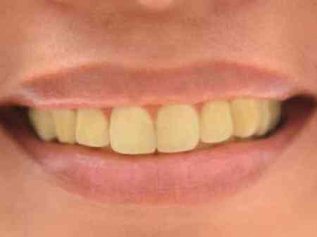 Dişlərin saralmasının əsas 9 SƏBƏBİ