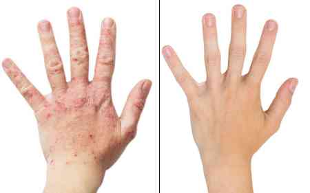 Dermatiti müalicə edən - 3 təbii RESEPT