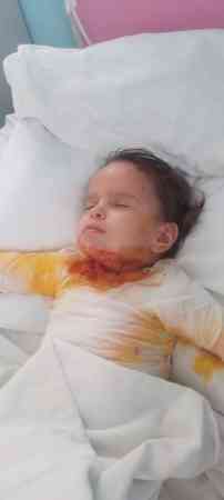 Ağır yanıq xəsarətləri alan körpənin dəstəyə ehtiyacı var - FOTO