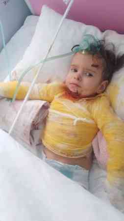 Ağır yanıq xəsarətləri alan körpənin dəstəyə ehtiyacı var - FOTO