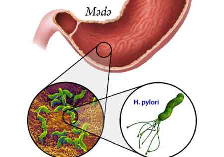 Mədə mikrobu hansı fəsadlara yol aça bilər?