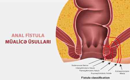 Fistula nə qədər ciddi problemdir? - Cərrah açıqlayır