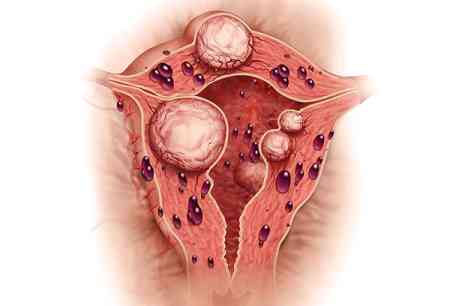 Qadınların sirli bəlası – Endometriozu necə aşkarlamaq olar?