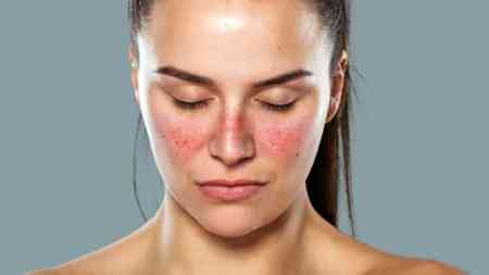 Lupus xəstəliyi nədir? Yaranma səbəbləri və müalicə yolları