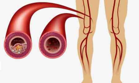 Hansı vitaminin əskikliyi damarları nazildir?