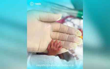 15 ildən sonra 540 qram çəkidə doğulan Nur... - FOTO